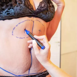 Liposuction