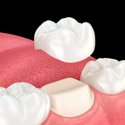 Dental Crowns