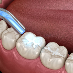 Dental Fillings