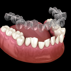 Clear Aligners