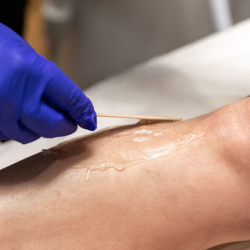 Laser Hair Removal