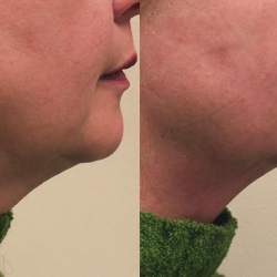 Chin/Jawline Revision