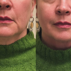 Jowls RF Treatment