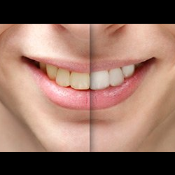 Teeth Whitening