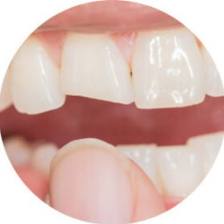 Cracked Teeth