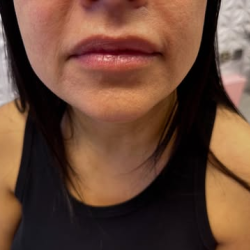 Lip Fillers