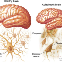 Treatment of Memory and Brain Disorders