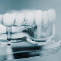 Dental Implants