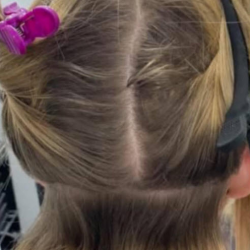 Scalp Treatments