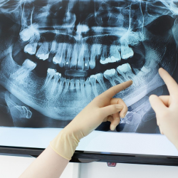 Full Arch Implant Reconstruction