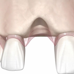 Bone grafting
