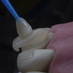 Soft Tissue Grafting for Implants
