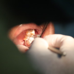 Wisdom Teeth Removal