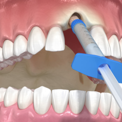 Bone Grafting