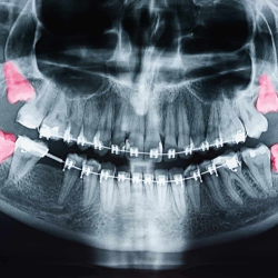 Impacted Teeth