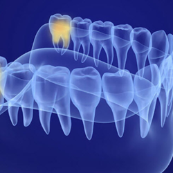 Wisdom Teeth Removal