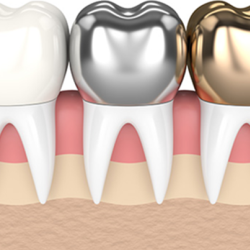 Dental Crowns in Las Vegas