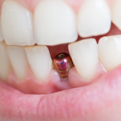 Implant Dentistry