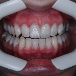 Full Mouth (All on X) Restoration