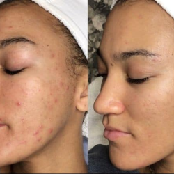 HydraFacials