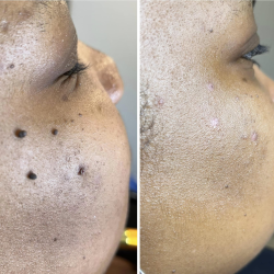 DPN and Mole Removal in Tallahassee, FL