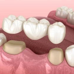 Dental Bridges