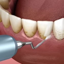 Teeth Cleaning (Prophy)