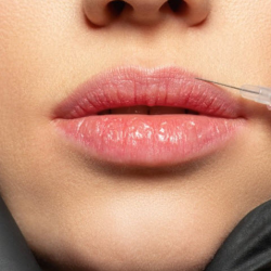 Dermal  Fillers