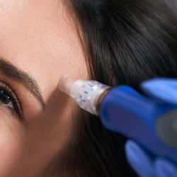 Microneedling