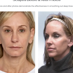 Collagen Biostimulator