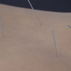 Dry Needling Therapy