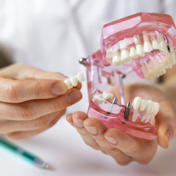 Dental Bridges
