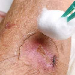 Complex and Non-Healing Wounds