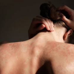 Take Part in Psoriasis Research