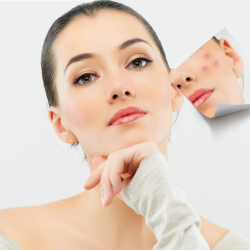 Acne Treatment