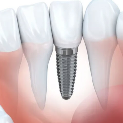 Dental Implants