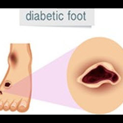 Diabetic foot care