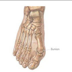 Bunions