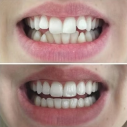 Invisalign