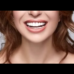 Veneers