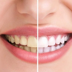 Tooth Whitening