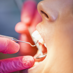 White composite fillings