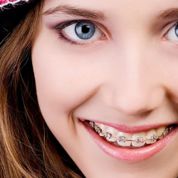 Braces