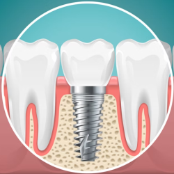 Implants