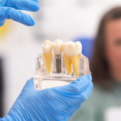 Dental Implants