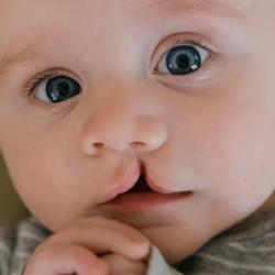 Cleft Lip and Palate / Craniofacial Care