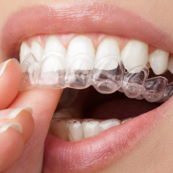 Invisalign and Spark Clear Aligners