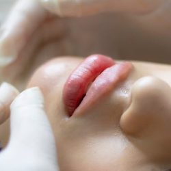 Dermal Filler Injectables