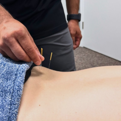 Acupuncture