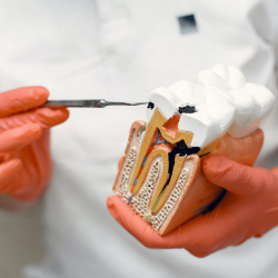 Root Canal Therapy